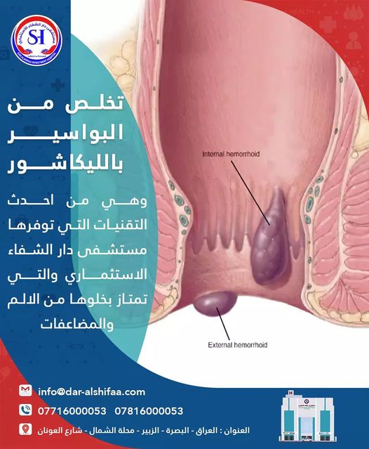 نقدم تقنية LigaSure الجديدة